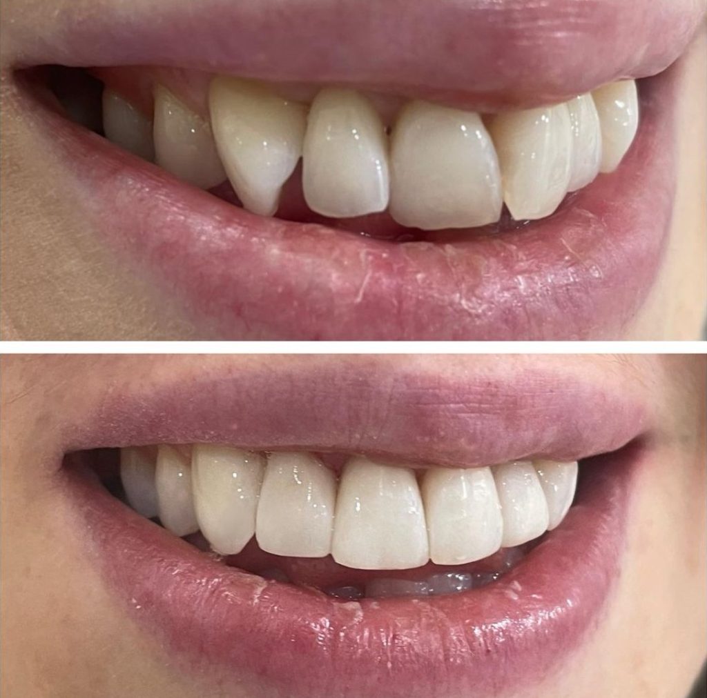 Building Confidence: The Subtle Impact of Composite Bonding on Oral Health