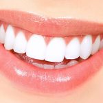Mastering the Art of Veneers for a Radiant Smile
