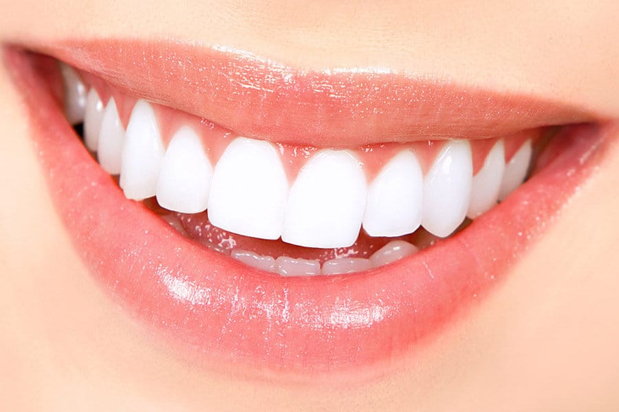 Mastering the Art of Veneers for a Radiant Smile