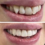 Building Confidence: The Subtle Impact of Composite Bonding on Oral Health