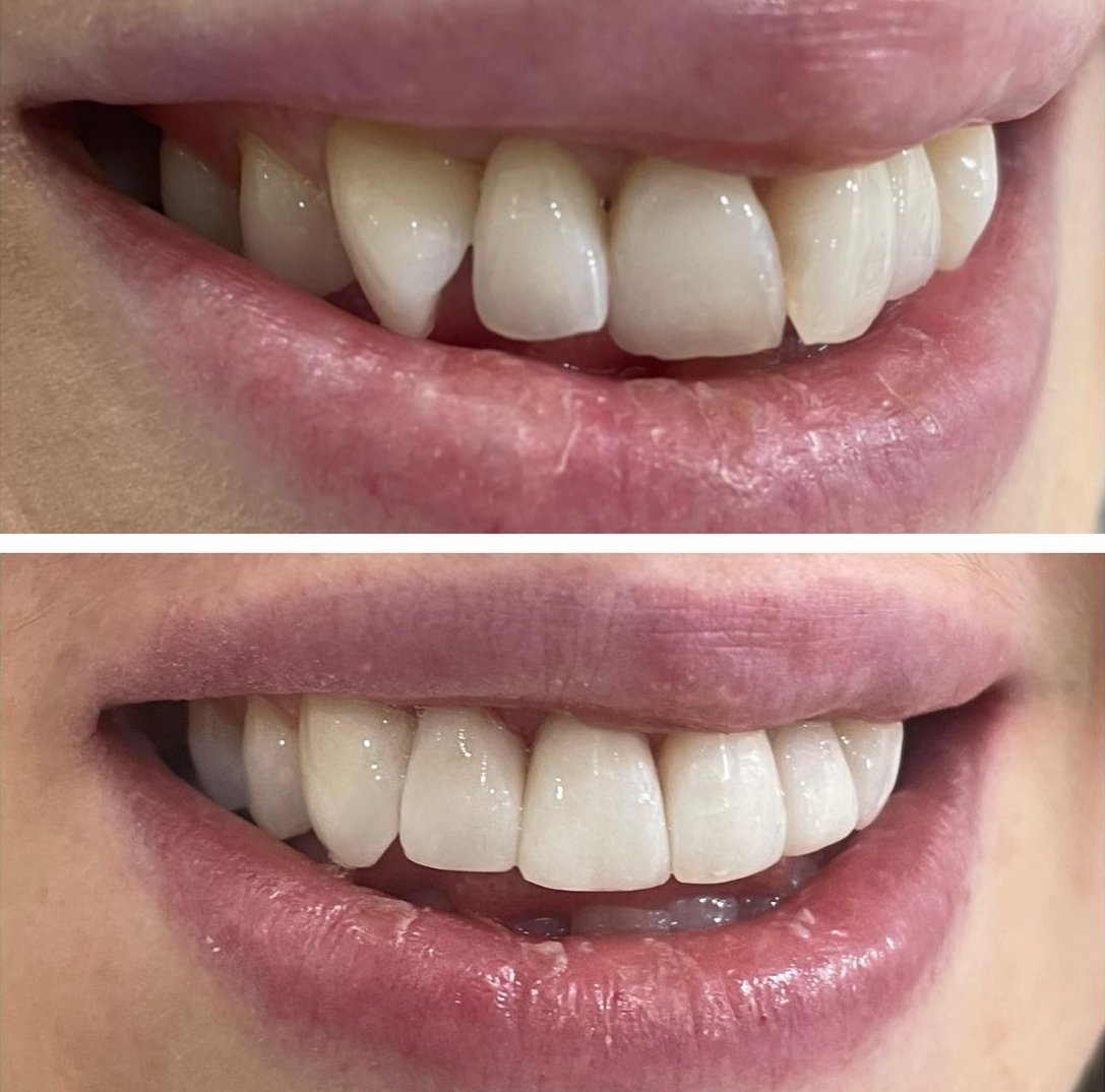 Building Confidence: The Subtle Impact of Composite Bonding on Oral Health